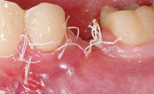 4 | Soft tissues healing after 7 days.