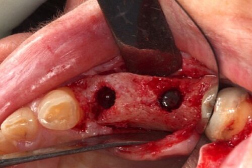 Bone preparation and osteotomy after extraction
