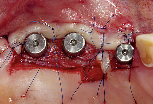 5/6 Rolling flap and apically repositioning to position the attached mucosa on the buccal side of the implants. Geistlich Mucograft® was used to create additional keratinized mucosa in situ.