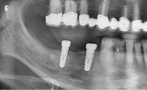 E | Radiological evaluation after insertion of implants into the regenerated alveolar ridge.