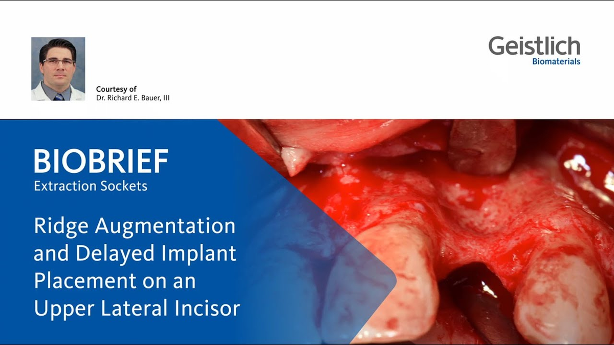 Ramal Bone Graft for Congenitally Missing Maxillary Lateral Incisor