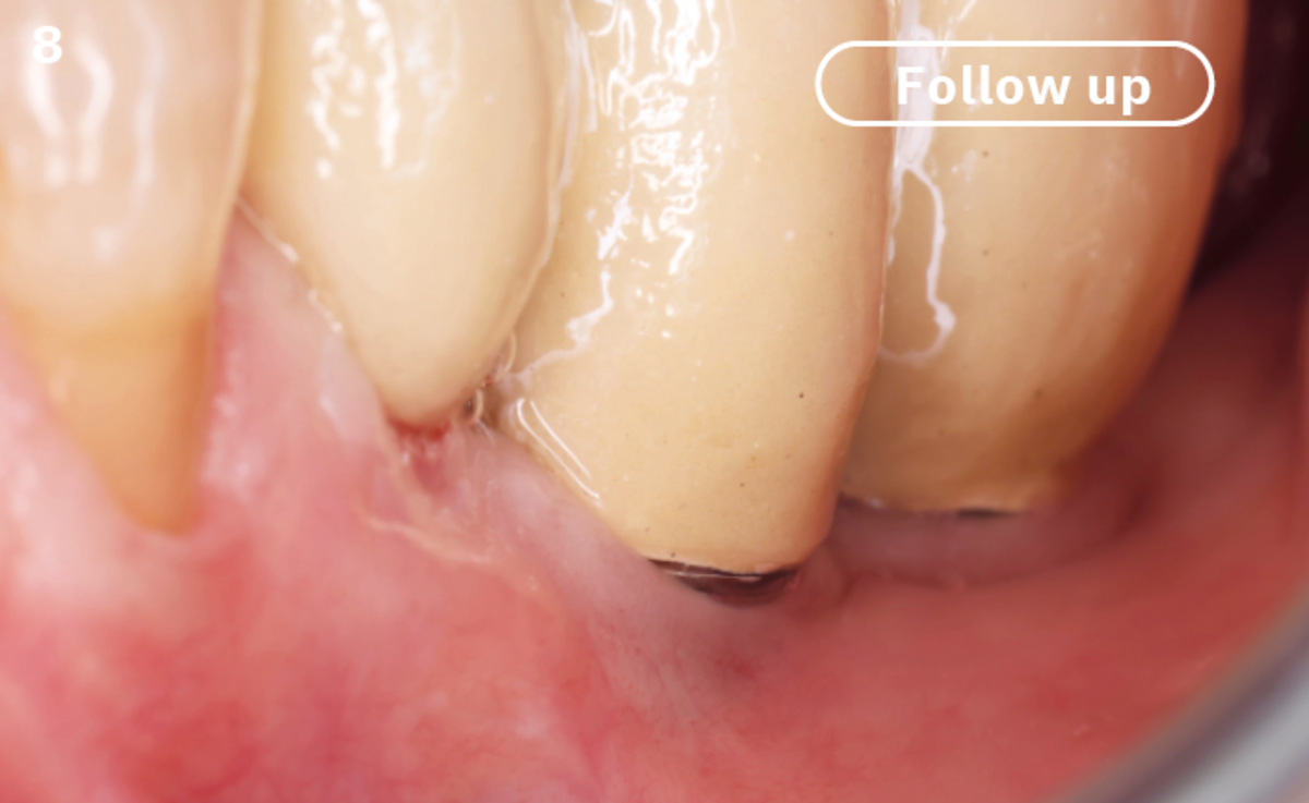 8 | At 1-year follow-up no signs of bleeding on probing, thin gingiva noticed and good oral hygiene