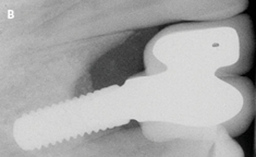 B | Periapical radiograph documenting extensive bone loss around the bone level implant in area 13.
