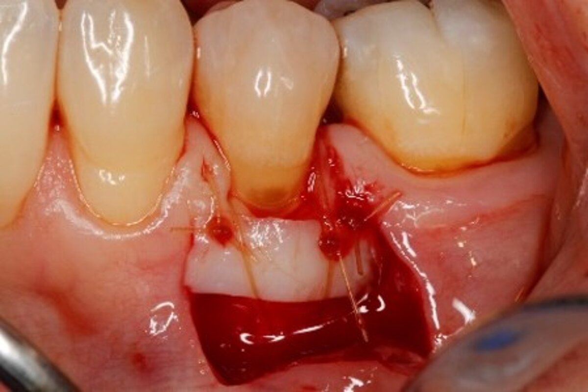 Recession coverage with free gingival graft- Surgery