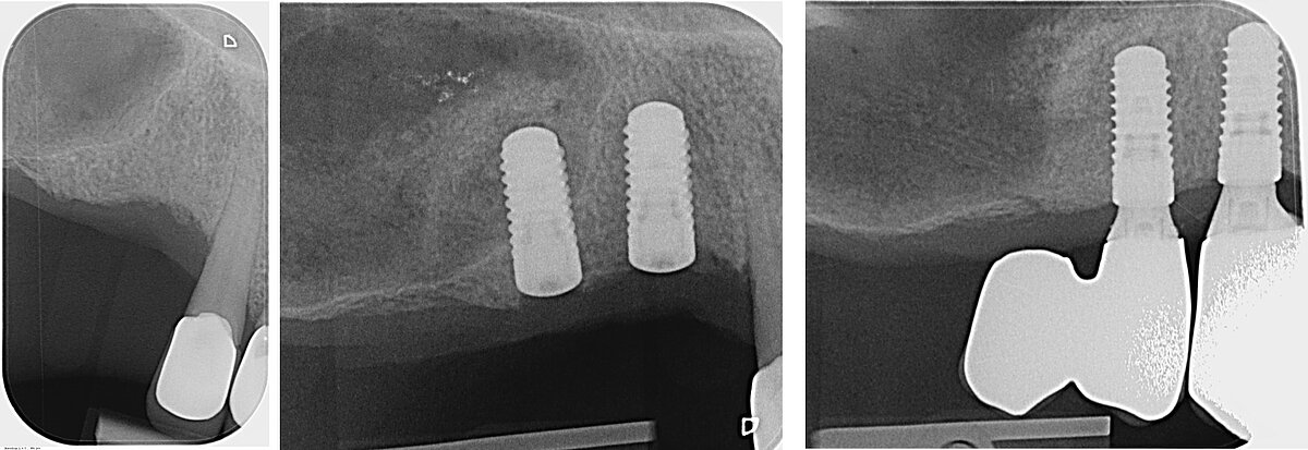 X-ray, before treatment (left), at sinus lift and implant placement (middle) and 2.5 months later at prosthesis fit (right)