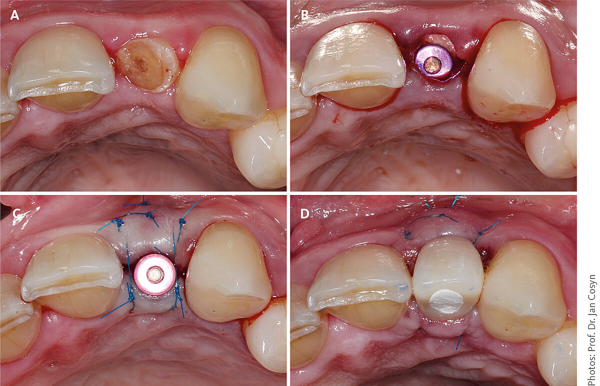 [Portuguese] A Pre-operative occlusal view of tooth 22 that needs to be replaced with an implant. | B Occlusal view following tooth extraction and immediate implant placement in a palatal position. Note that the bone gap was filled with deproteinized bovine bone mineral (Geistlich Bio-Oss® particles). | C A thin connective tissue graft from the palate was inserted into the buccal pouch and secured with monofilament suture material. | D Occlusal view two days following surgery upon placement of the provisional crown.