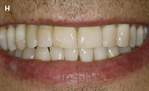 H | Smile line of the patient following delivery of the new implant-supported reconstruction.