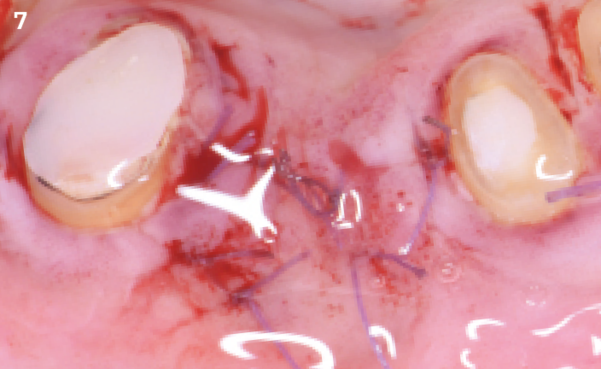 7 | After the suture, the excess part of the product is applied on the suture line.