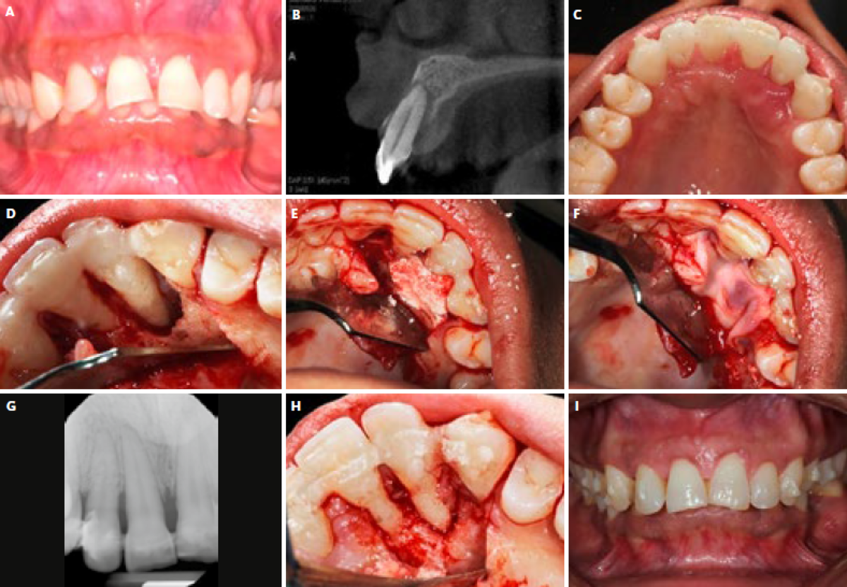  A Avant le traitement orthodontique. | B CBCT périapicale avant le traitement parodontal. | C Attelles de contention sur les dents (13–23). | D Poche intra-osseuse de 7 mm après ouverture du lambeau. | E Comblement du défaut avec  Geistlich  Bio-Oss® Collagen. | F Recouvrement du greffon osseux avec Bioactive L-PRF™. | G Radiographie périapicale au suivi à 12 mois. | H Os nouvellement formé autour de la 11 et la 12 lors de la réouverture.| I Résultat final.
