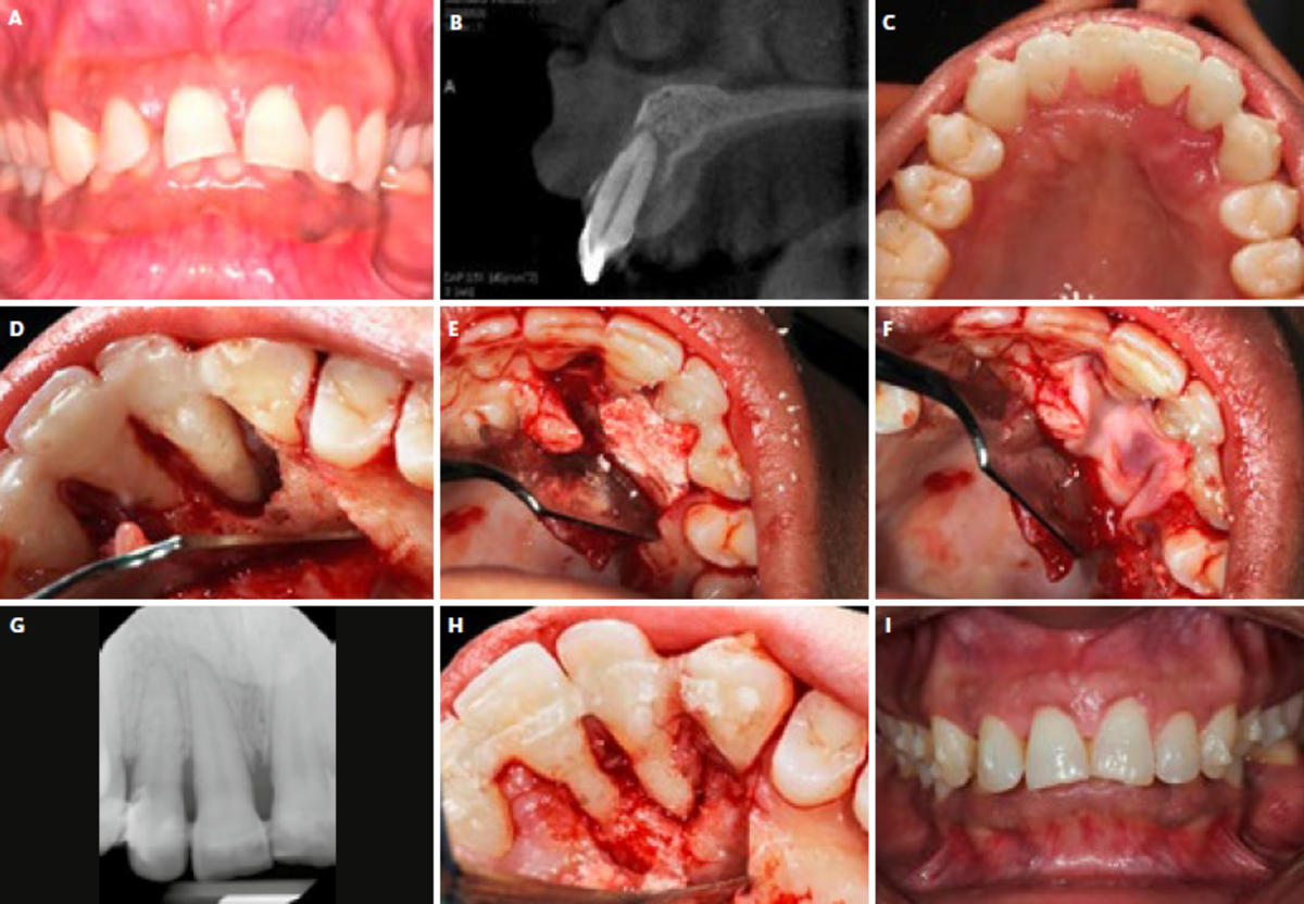 | A До ортодонтического лечения | B КЛКТ до пародонтологического лечения. | C Шинирование зубов #13‑23. | D После отслаивания лоскута визуализирован 7 милиметровый внутрикостный дефект. | E Заполнение дефекта Geistlich Bio-Oss ® Collagen. | F Костный материал сверху закрыт биоактивным L-PRF™. | G Периапикальная рентгенограмма через 12 месяцев после операции. | H Формирование новой костной ткани вокруг зубов 11 и 12.| I Окончательный результат.