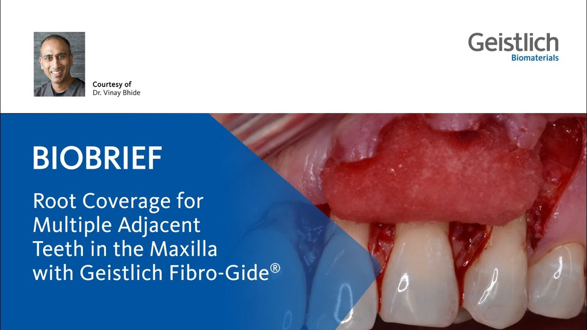 Root Coverage for Multiple Adjacent Teeth in the Maxilla with Geistlich Fibro-Gide®