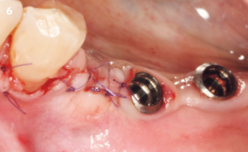 6 | Tension-free flap repositioning using sutures (6-0 slower resorption)