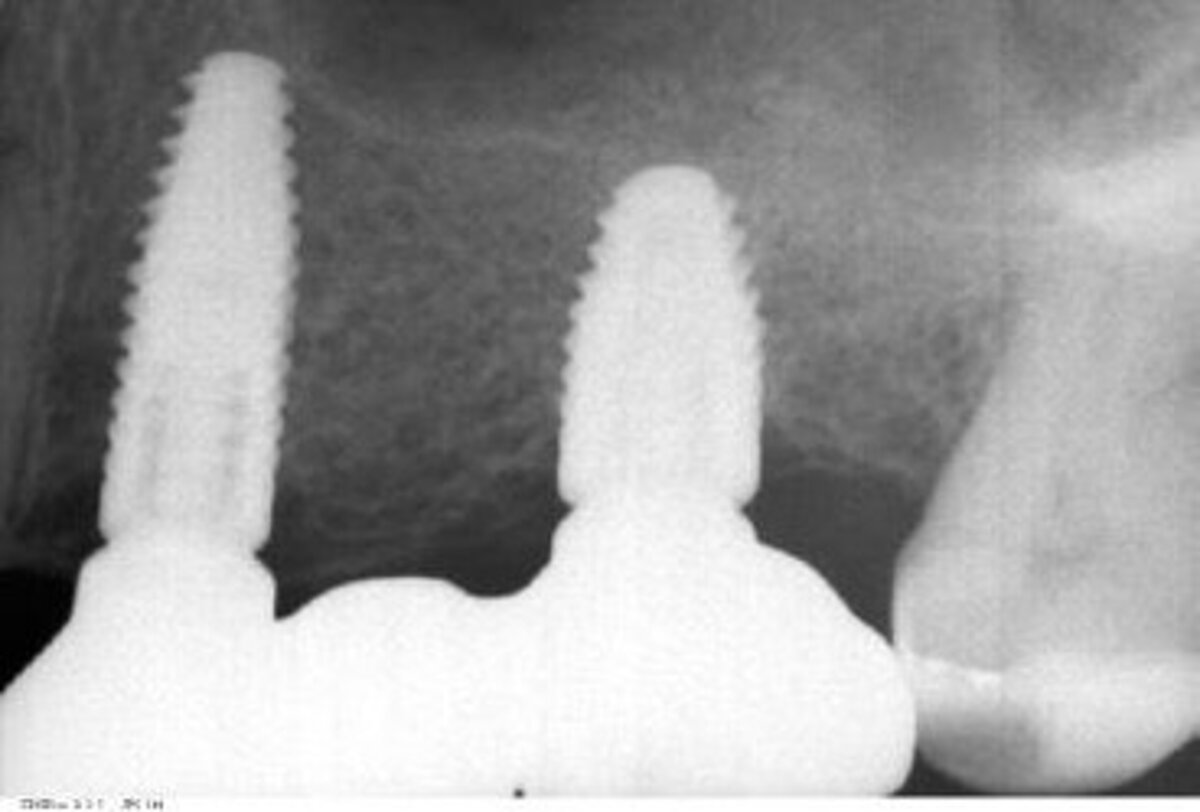 Periapical X-ray at 13 months follow-up (restoration in place)