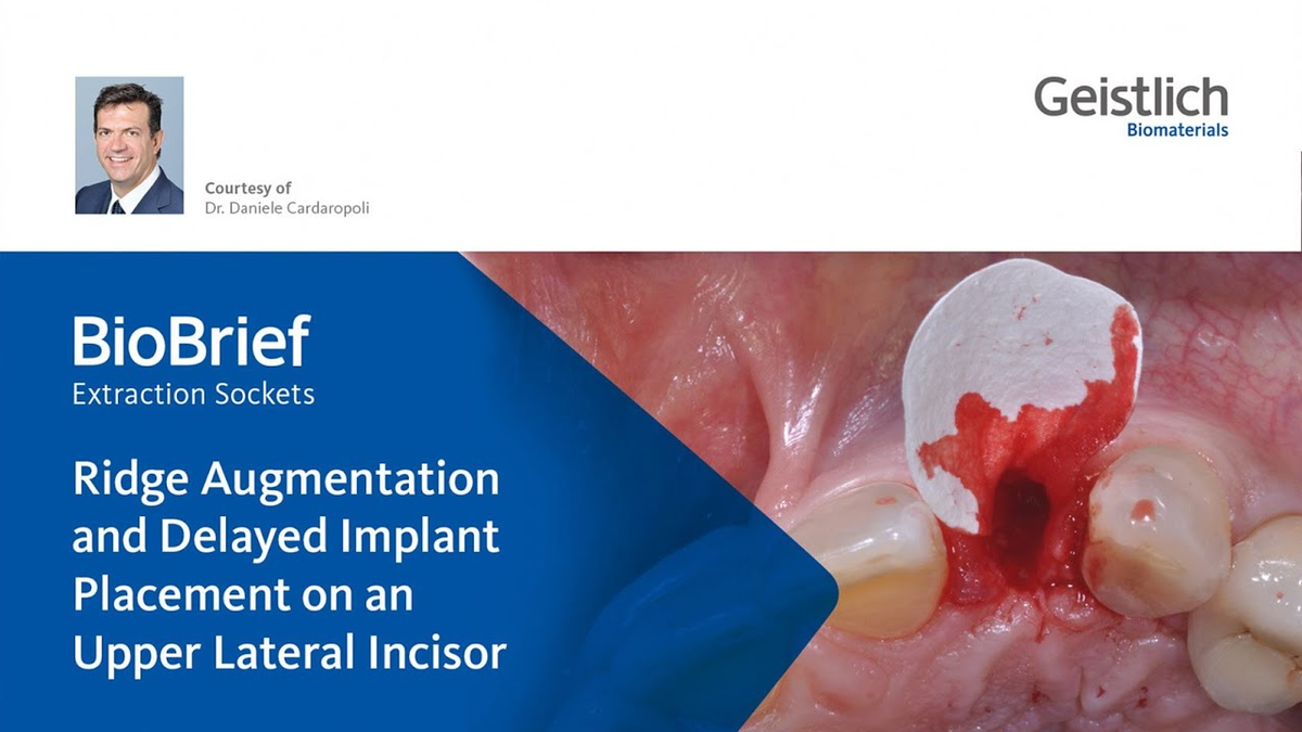 Ridge Augmentation and Delayed Implant Placement on an Upper Lateral Incisor