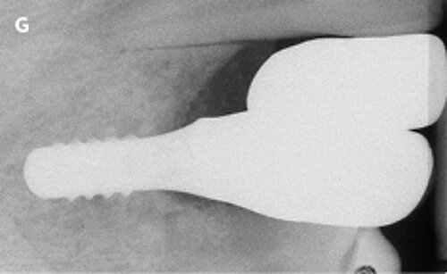 G | Periapical radiograph of the new tissue level implant in area 13.