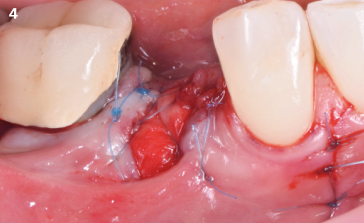 4 | The flap is repositioned in its initial position with 5-0 polyamide sutures, leaving the membrane to heal occlusally by second intention.