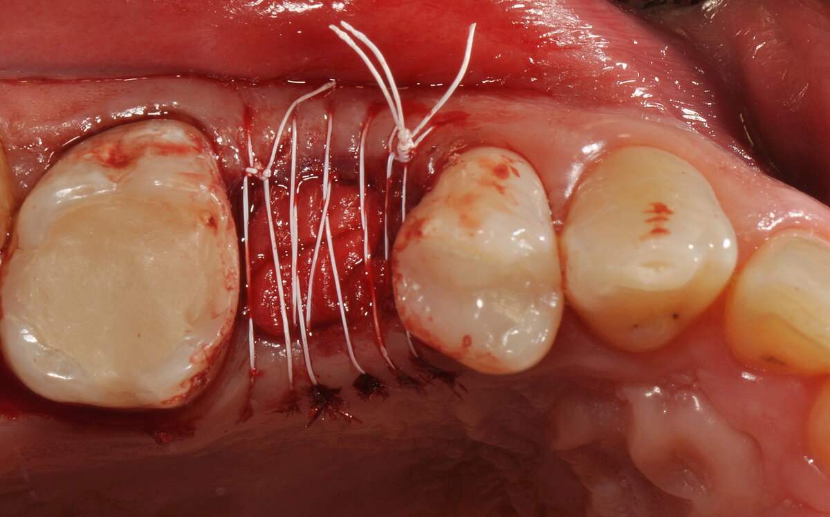 covered with Geistlich Bio-Gide® collagen membrane stabilized by PTFE continuous suture.