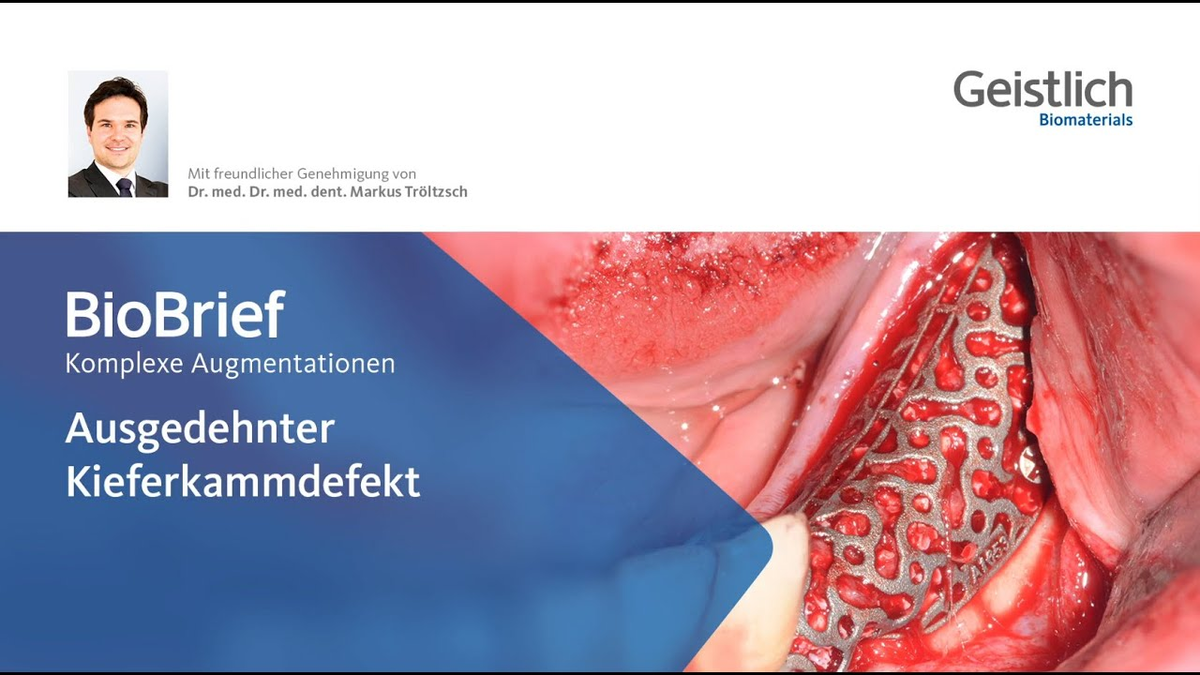 Komplexe Augmentation - Ausgedehnter Kieferkammdefekt