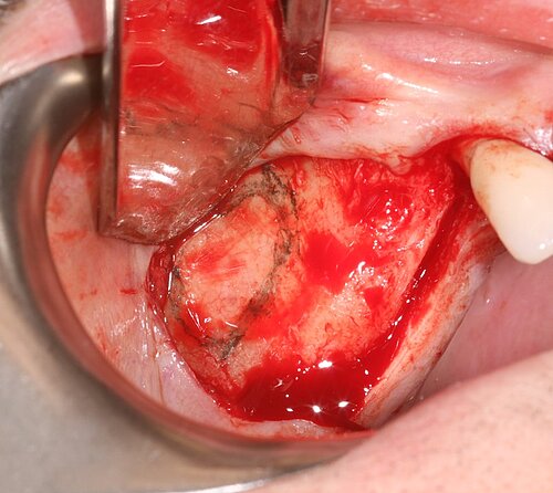 Fig 2- Mucoperiosteal full-thickness flap