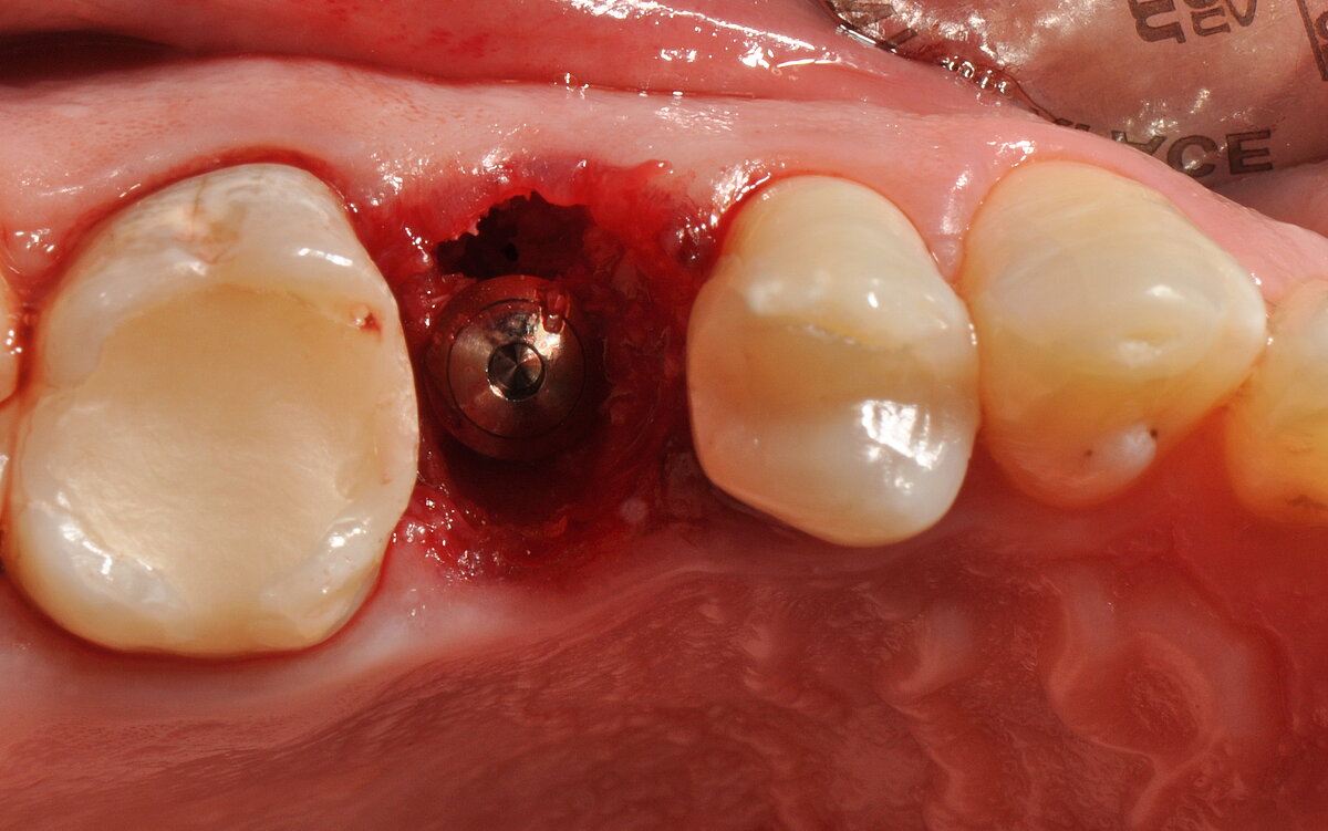 Immediate implant placement in the extraction socket,