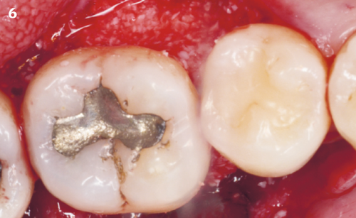 6 | Occlusal view of defect filled with a mix of Geistlich Bio-Oss® and REGENFAST®