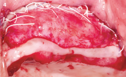 4 | The strip is stabilized with 6-0 monofilament
sutures. Horizontal mattress sutures (PTFE4-0) are used to anchor the strip to the periosteum.