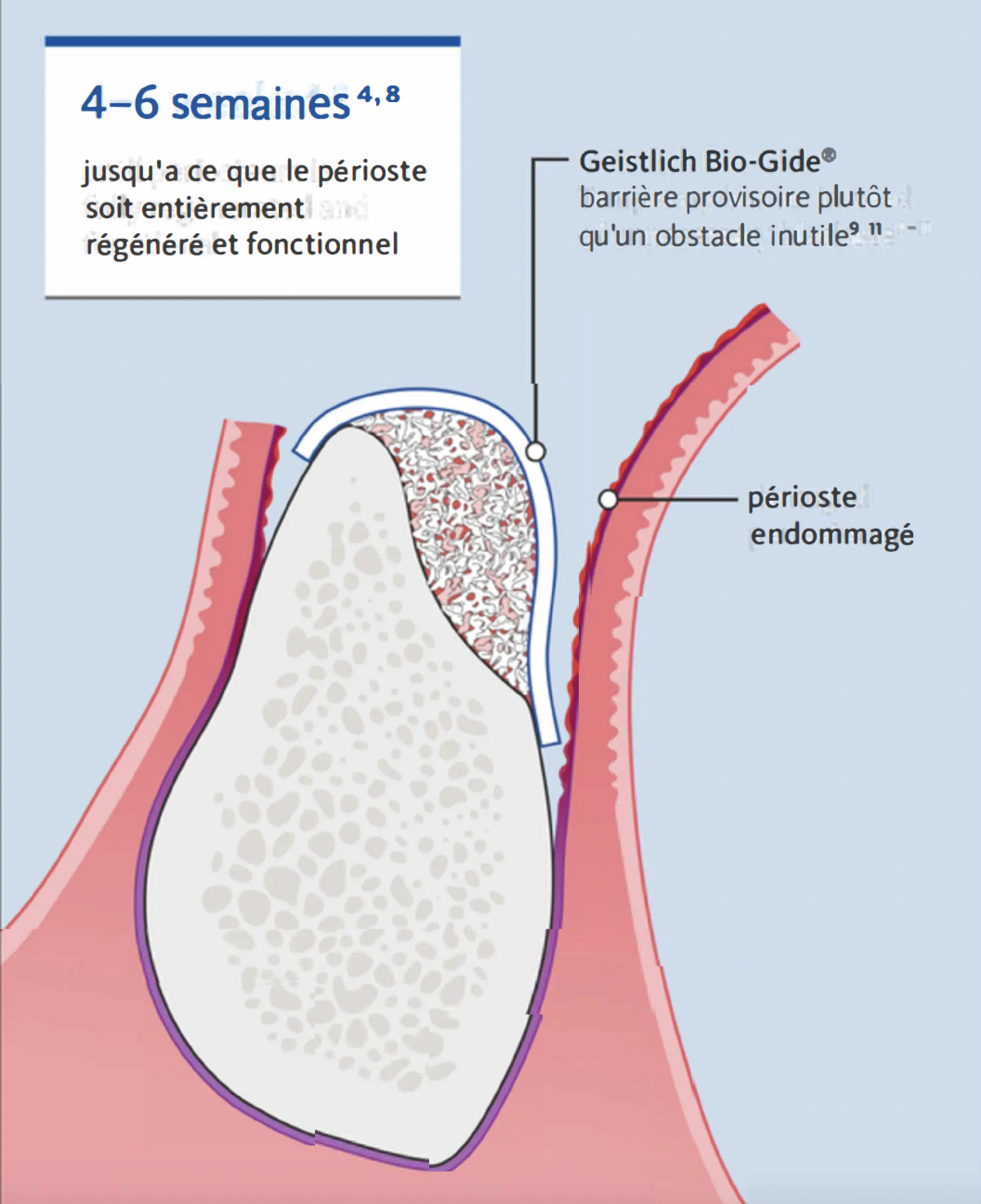 Explication sur le périoste endommagé et le temps barrière.