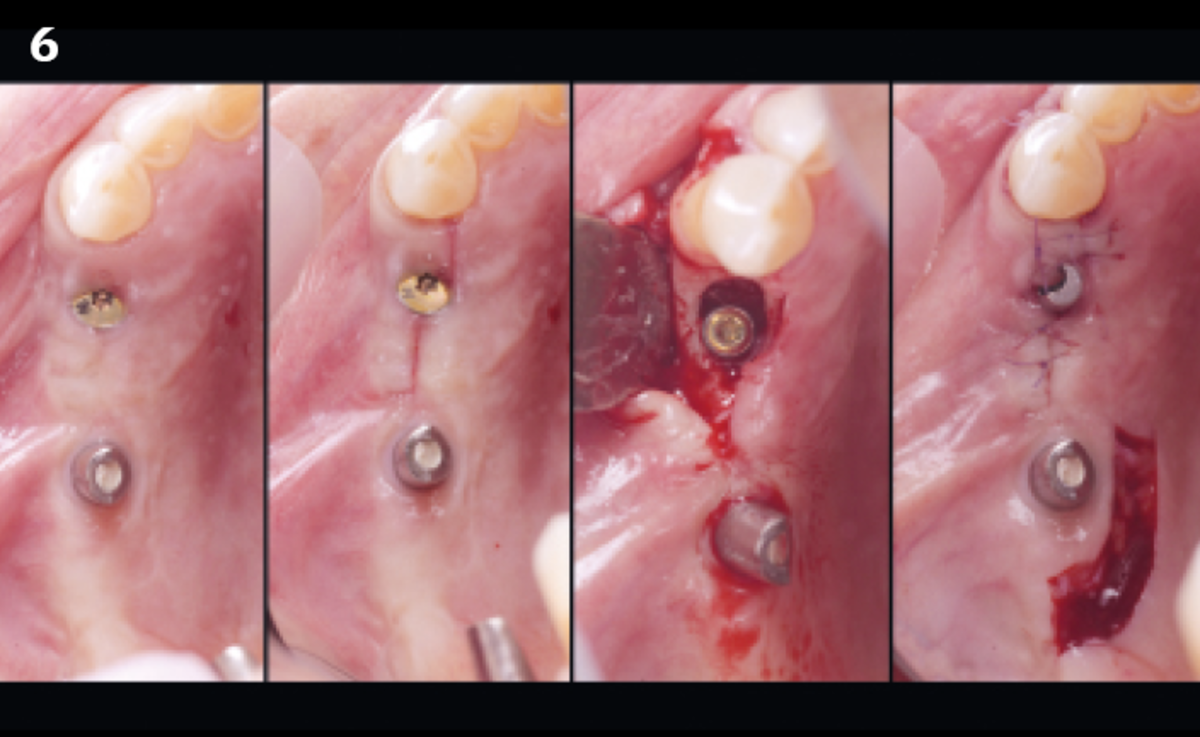 6 | Healing progress from wound closure until 1 month