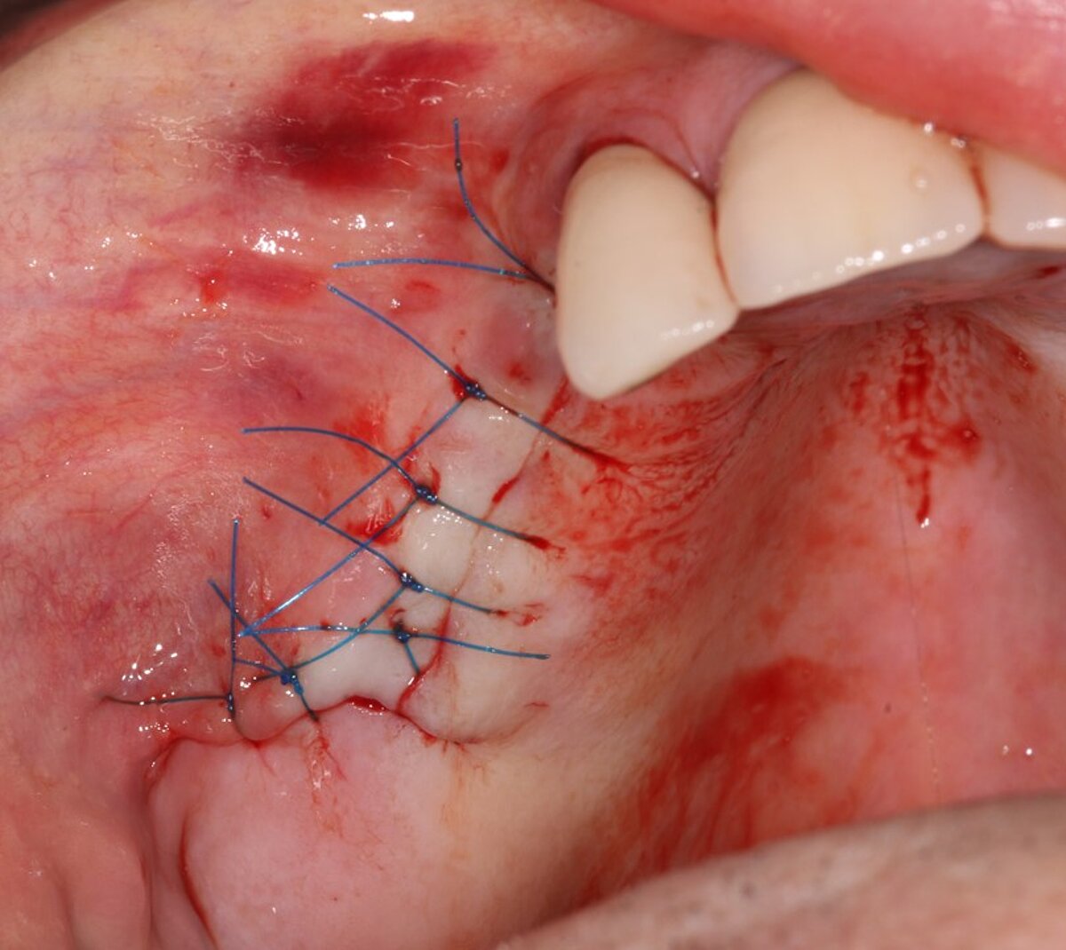 Fig 10- Periosteal relieving incision for tension free closure