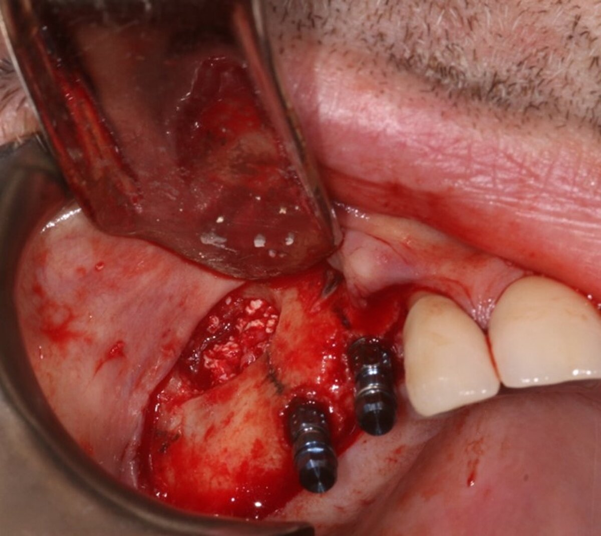 Fig 8- Implant introduction