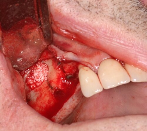 Fig 7- Sinus graft performed with a mix of 75% Geistlich Bio-Oss® and 25% autologous chips 