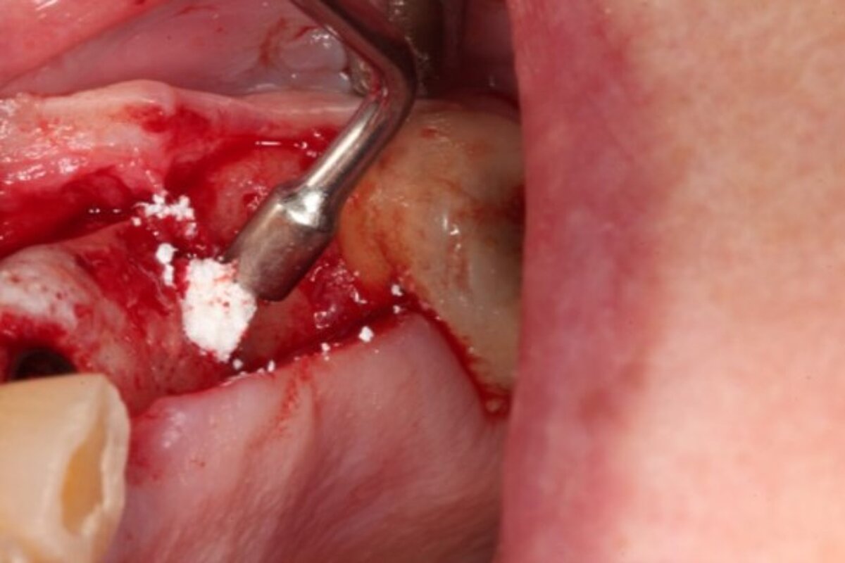 Geistlich Bio-Oss Collagen at tooth position 24