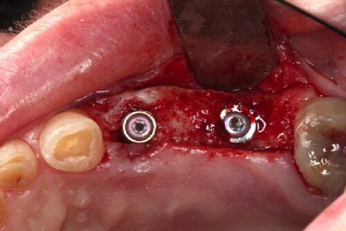 Bone-level implants inserted