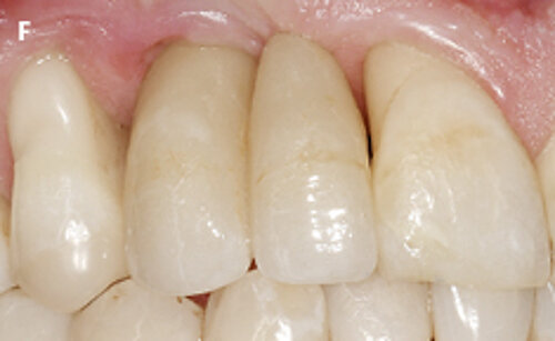 Fig. 1: Failed prevention: A 33 years old patient had lost teeth 12 and 13 (FDI Dental scheme) in a sports accident. He had received a buccally placed implant immediately after site augmentation. The site had shown early infection and soft tissue healing F | New screw-retained crown on implant 13 with mesial cantilever extension.
