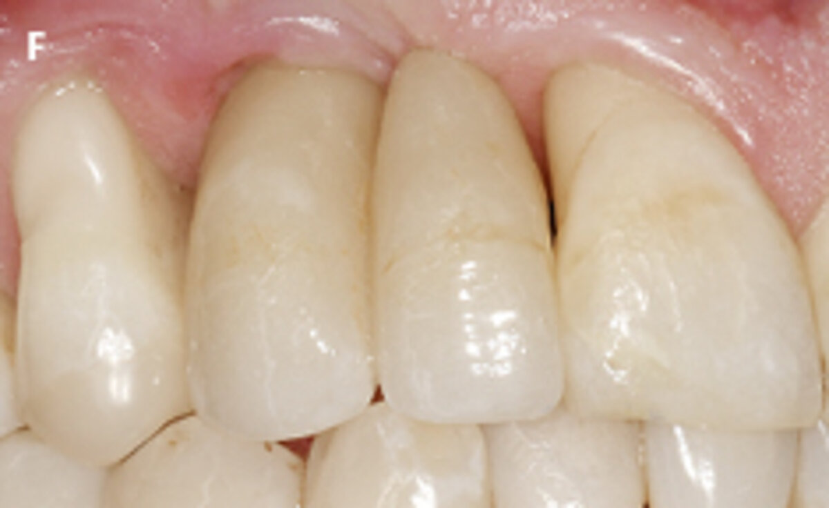 Fig. 1: Failed prevention: A 33 years old patient had lost teeth 12 and 13 (FDI Dental scheme) in a sports accident. He had received a buccally placed implant immediately after site augmentation. The site had shown early infection and soft tissue healing F | New screw-retained crown on implant 13 with mesial cantilever extension.