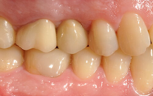 Healthy soft-tissue and esthetic outcome 1 year postoperative (left), 