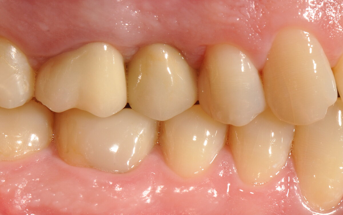 Healthy soft-tissue and esthetic outcome 1 year postoperative (left), 