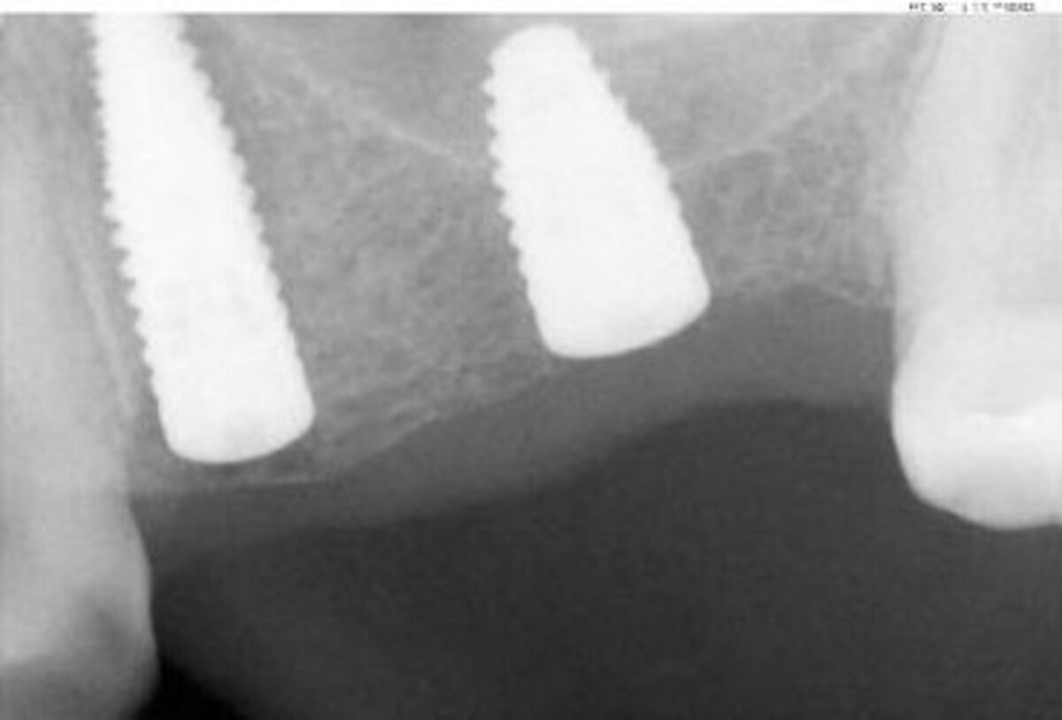 Periapical X-ray at implant insertion