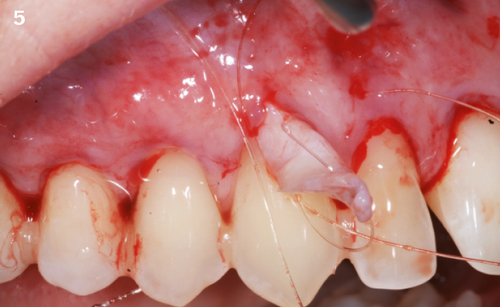 5 | Connective tissue inserted under the flap by two mattress sutures, one on each graft extremity.