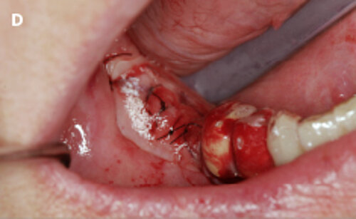 D | Protection of the soft tissue edges, after suturing, using a dressing template.