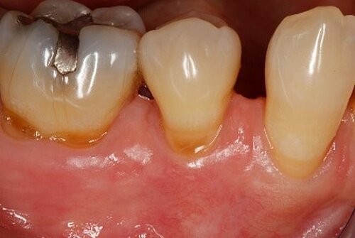 Recession coverage with Geistlich Mucograft Berfore treatment