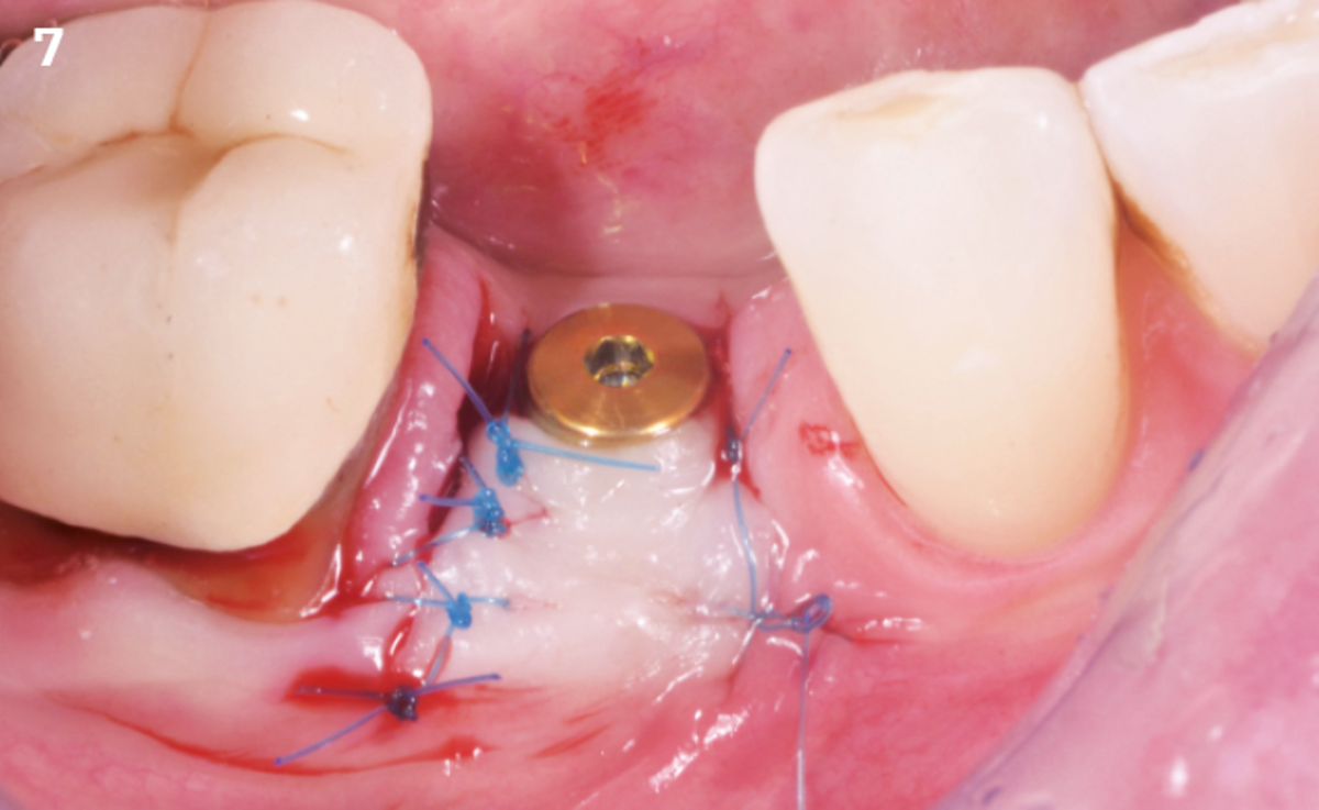 7 | The flap is moved vestibular and sutured.