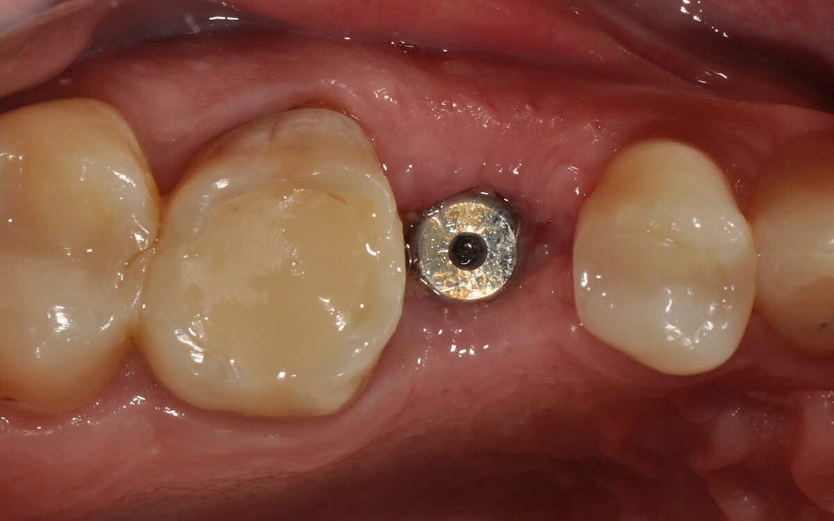 e duas semanas após a cirurgia (da esquerda para a direita)