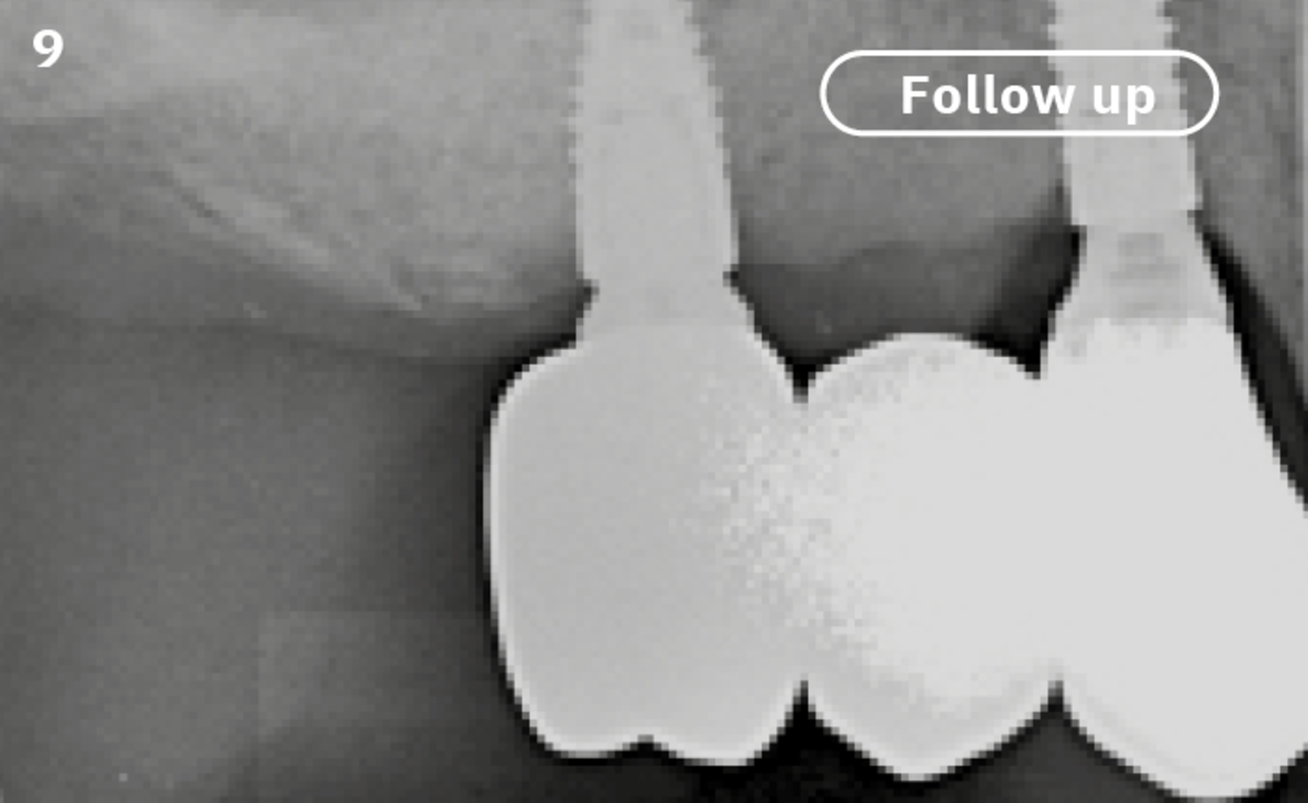 9 | The radiographic image 1 year after surgery shows the good bony situation