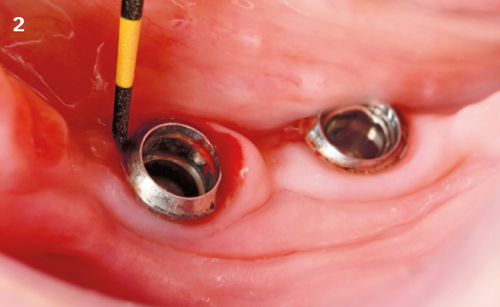 2 | Probing pocket depth (PPD) = 6 mm on implant 46