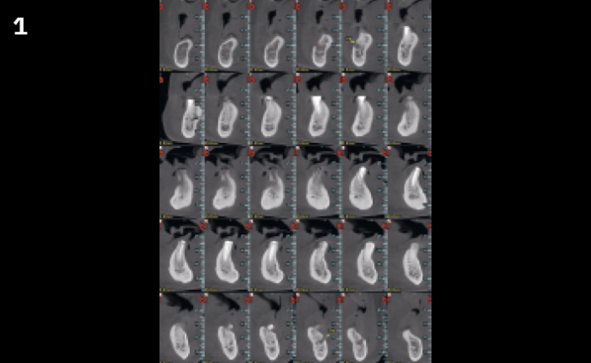 1 | Cone beam sections show a fragment of
necrotic bone.