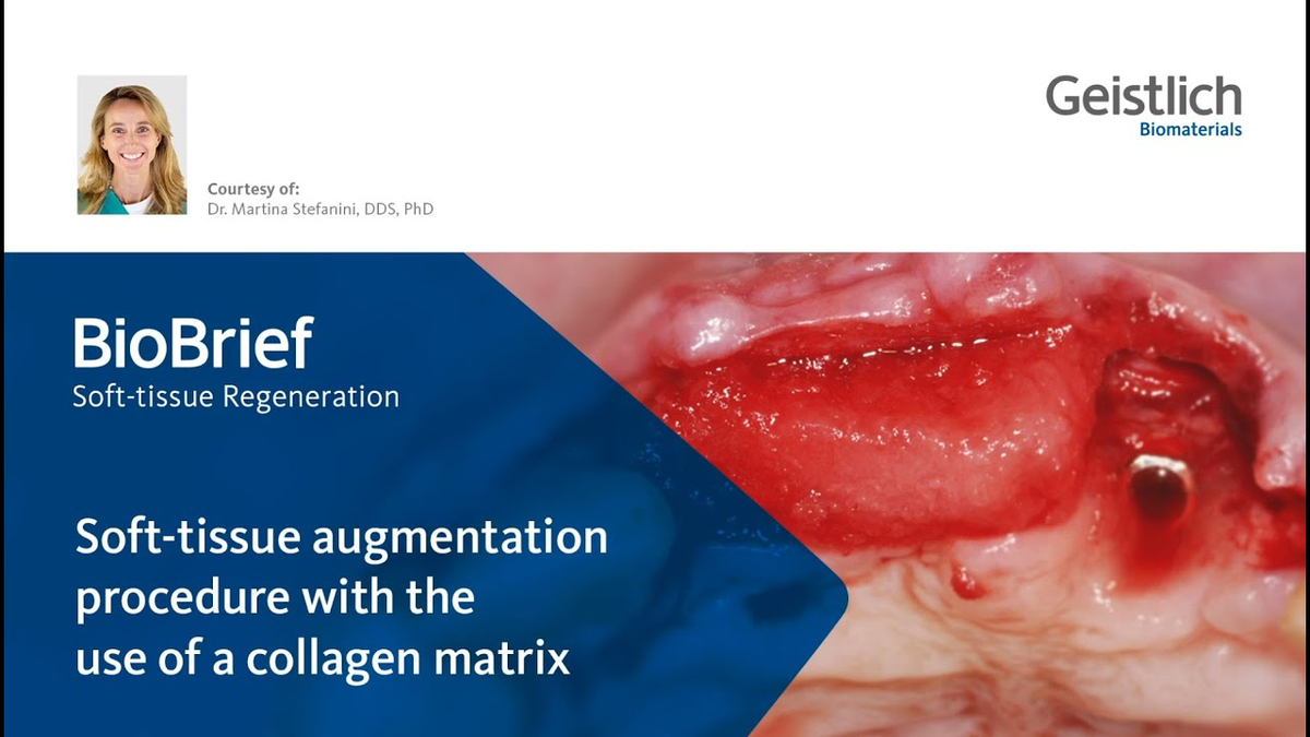 Dr. Martina Stefanini: Soft-tissue augmentationprocedure with the use of a collagen matrix