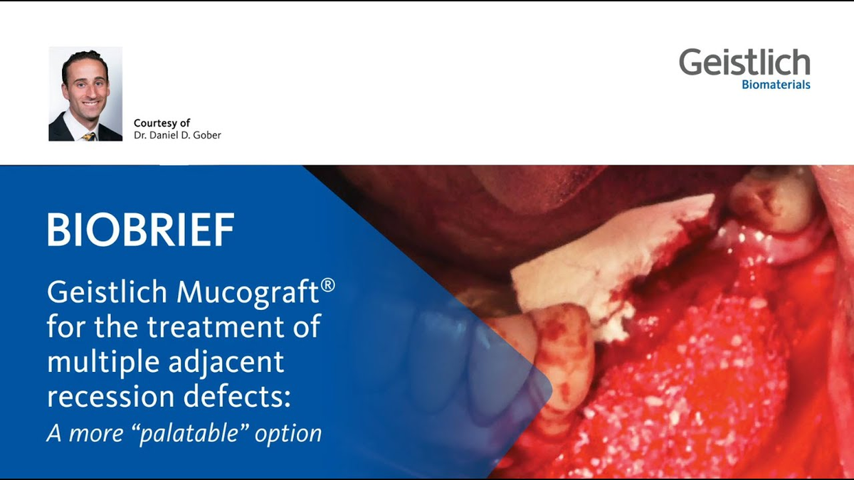 Geistlich Mucograft® for the treatment of multiple adjacent recession defects
