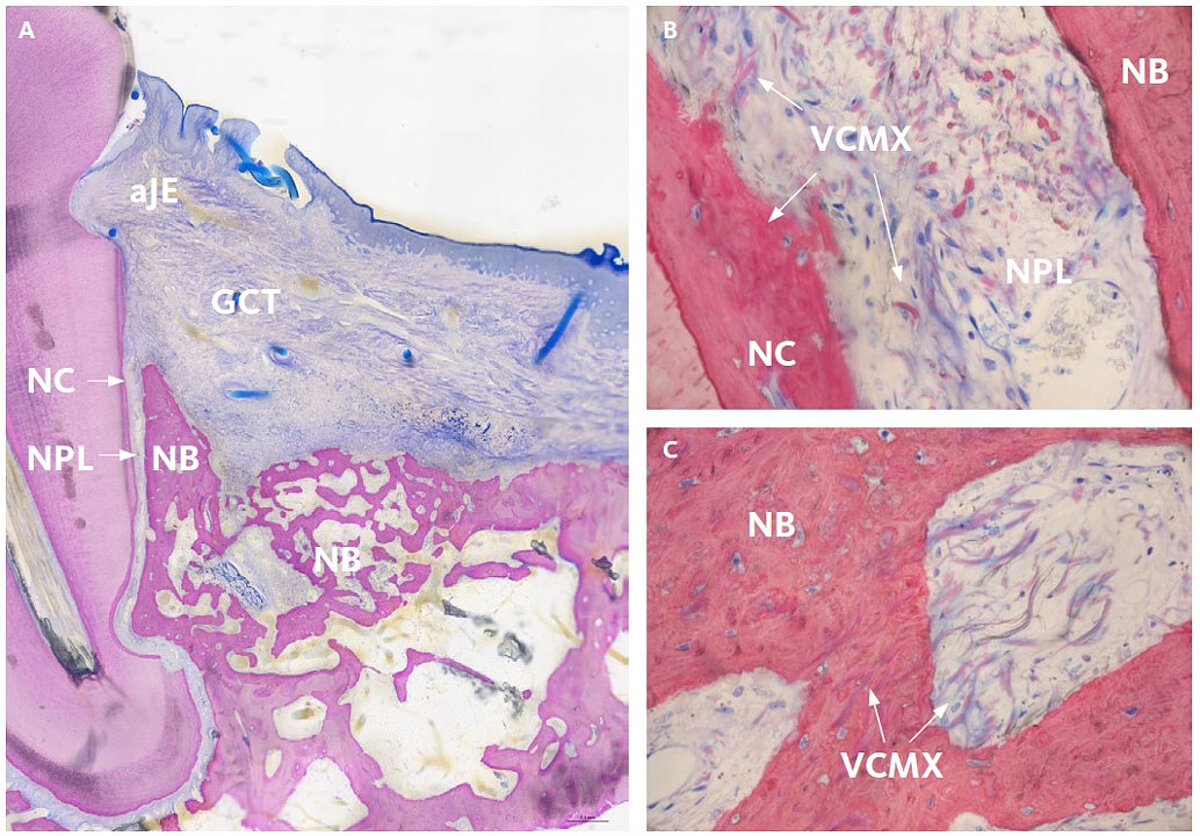 Periodontal defect regenerated with the use of Geistlich Fibro-Gide®