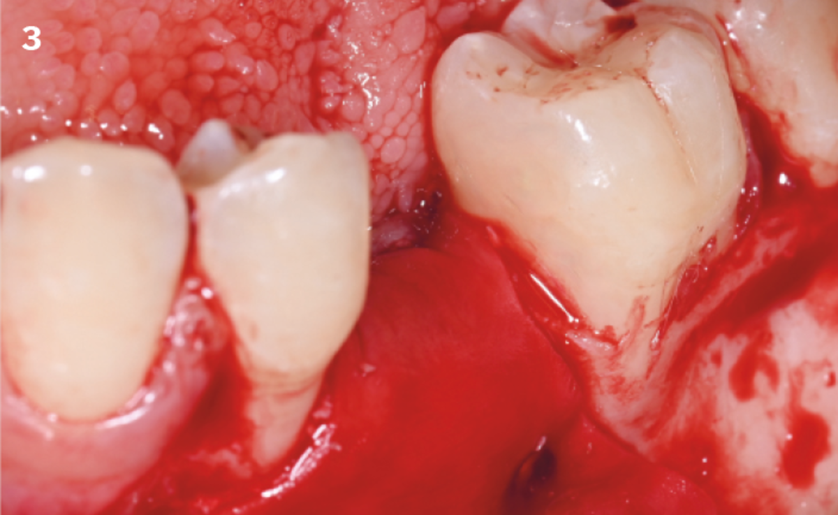 3 | A Geistlich Bio-Gide® Compressed membrane is fixated with surgical pins first on the lingual side and then on the vestibular side.